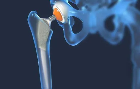 Human Implants